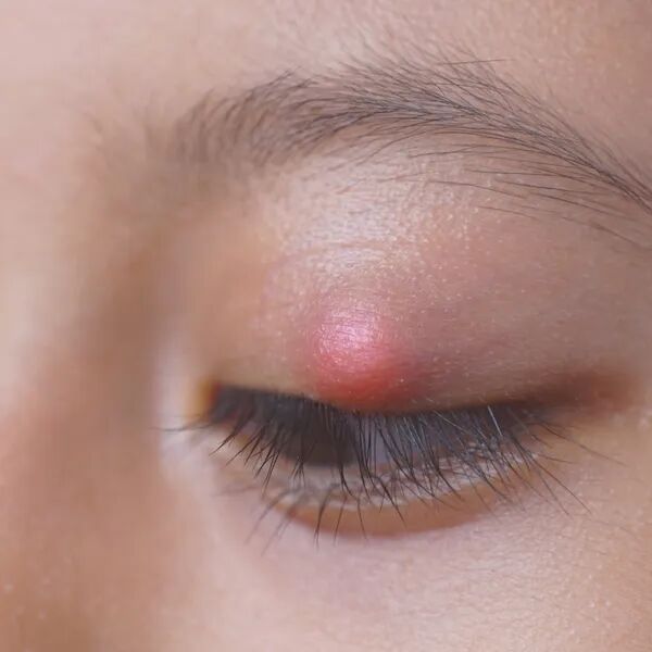 Paupières gonflées que faire 👁️